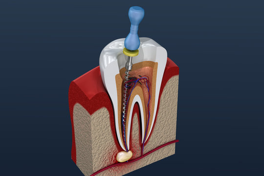 Root Canal